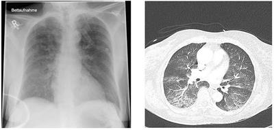 An update on environment-induced pulmonary edema – “When the lungs leak under water and in thin air”